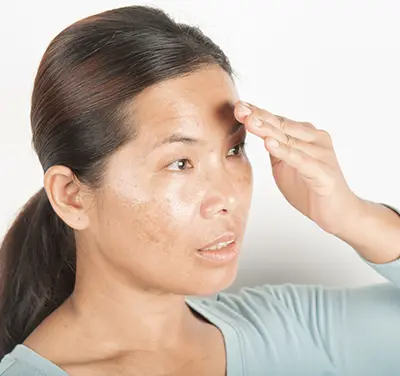 Hyperpigmentation Treatment